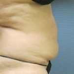 Liposuction Female Before & After Patient #1177