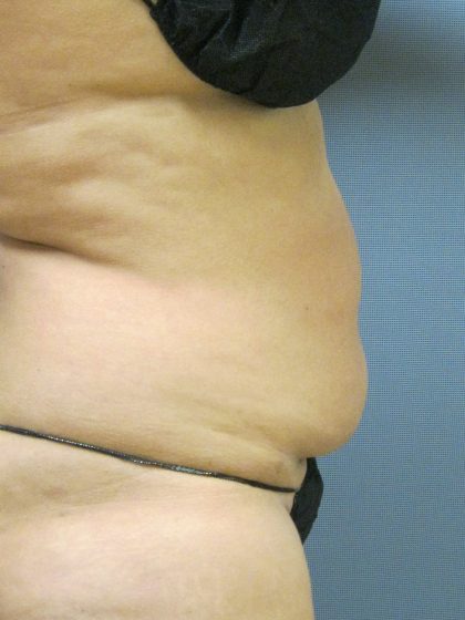 Liposuction Female Before & After Patient #1177