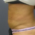 Liposuction Female Before & After Patient #1177