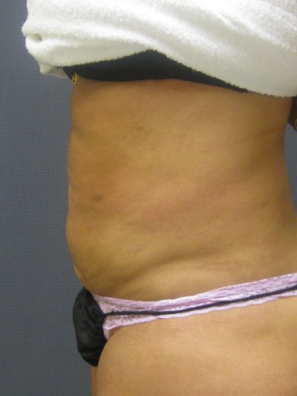 Liposuction Female Before & After Patient #1177