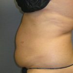 Liposuction Female Before & After Patient #1177