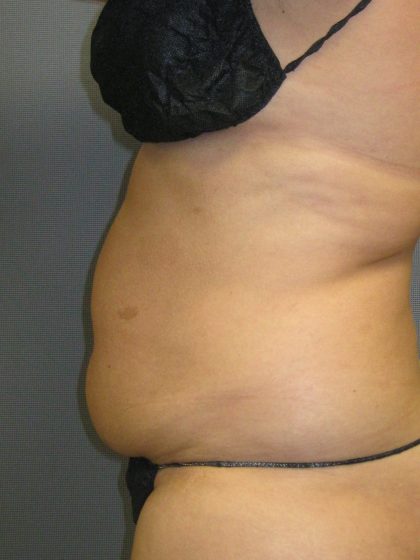 Liposuction Female Before & After Patient #1177