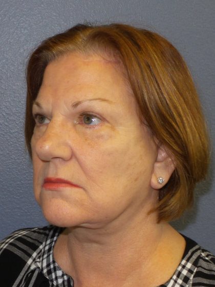 Brow Lift Before & After Patient #193