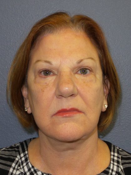 Facelift Before & After Patient #880