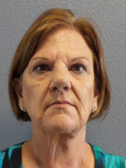 Facelift Before & After Patient #880