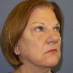Facelift Before & After Patient #880