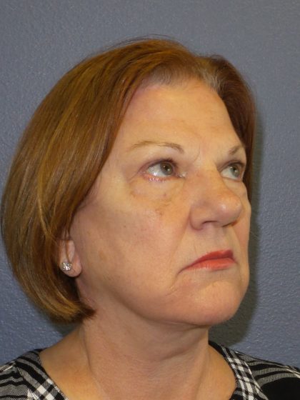 Facelift Before & After Patient #880