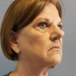 Facelift Before & After Patient #880