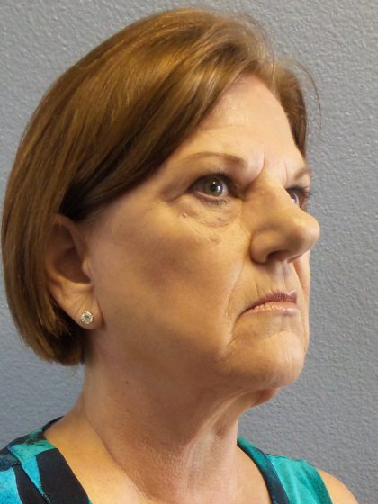 Facelift Before & After Patient #880