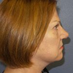 Facelift Before & After Patient #880