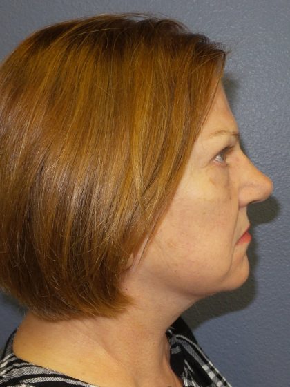 Facelift Before & After Patient #880