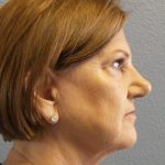 Facelift Before & After Patient #880