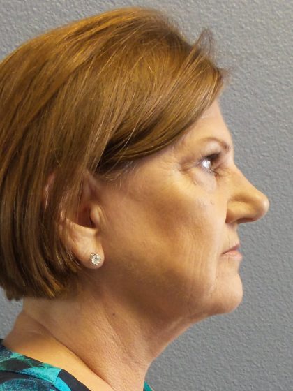 Facelift Before & After Patient #880