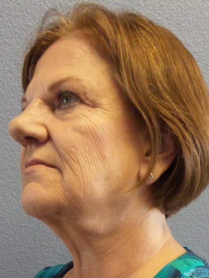 Facelift Before & After Patient #880