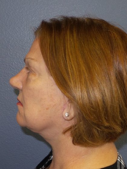Facelift Before & After Patient #880
