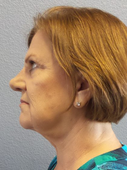 Facelift Before & After Patient #880