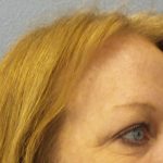 Blepharoplasty Before & After Patient #1285