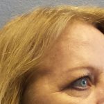 Blepharoplasty Before & After Patient #1285
