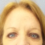 Brow Lift Before & After Patient #198