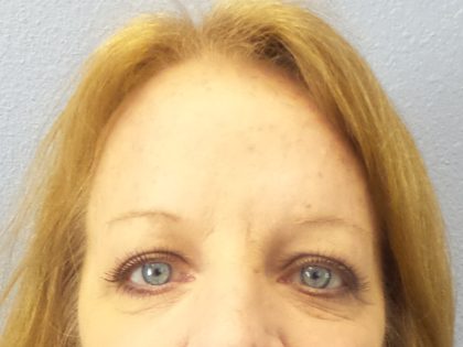 Brow Lift Before & After Patient #198