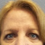 Brow Lift Before & After Patient #198