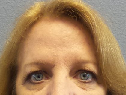 Brow Lift Before & After Patient #198