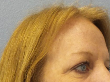 Brow Lift Before & After Patient #198