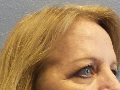 Brow Lift Before & After Patient #198