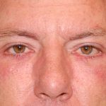Blepharoplasty Before & After Patient #1254