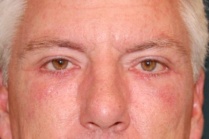 Blepharoplasty Before & After Patient #1254