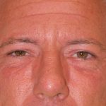 Blepharoplasty Before & After Patient #1254