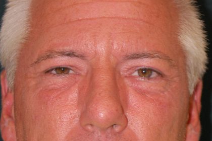 Blepharoplasty Before & After Patient #1254