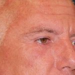 Blepharoplasty Before & After Patient #1254