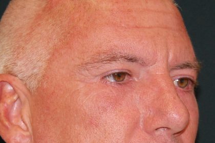 Blepharoplasty Before & After Patient #1254