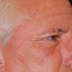 Blepharoplasty Before & After Patient #1254
