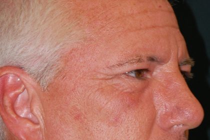 Blepharoplasty Before & After Patient #1254