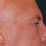 Blepharoplasty Before & After Patient #1254