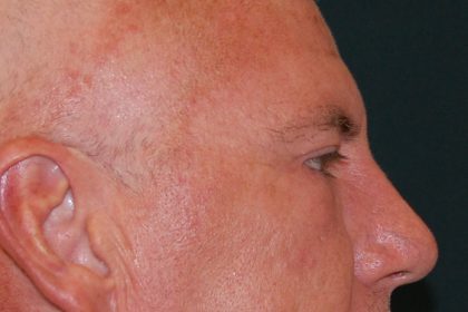 Blepharoplasty Before & After Patient #1254