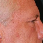 Blepharoplasty Before & After Patient #1254