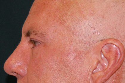 Blepharoplasty Before & After Patient #1254