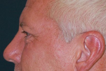 Blepharoplasty Before & After Patient #1254