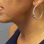 Liposuction of the Neck Before & After Patient #413
