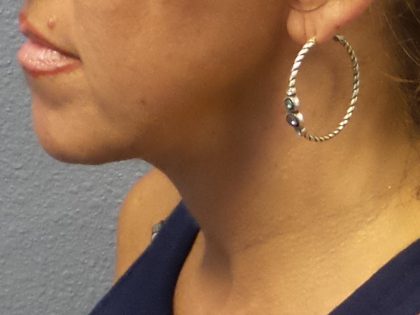 Liposuction of the Neck Before & After Patient #413