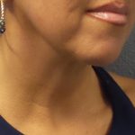 Liposuction of the Neck Before & After Patient #413