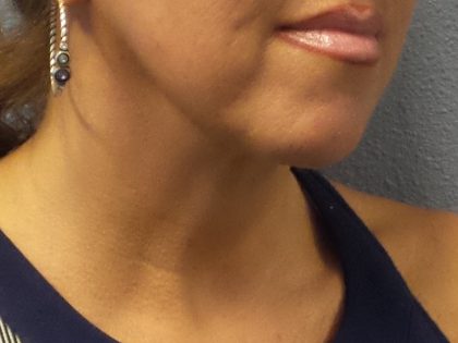 Liposuction of the Neck Before & After Patient #413