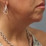 Liposuction of the Neck Before & After Patient #413