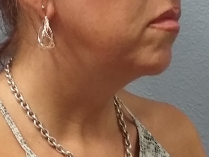 Liposuction of the Neck Before & After Patient #413