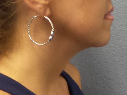 Liposuction of the Neck Before & After Patient #413