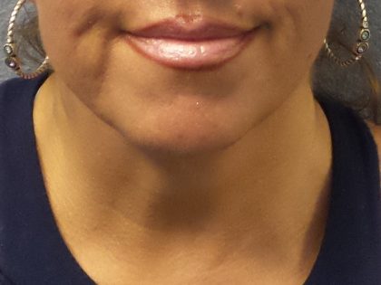 Liposuction of the Neck Before & After Patient #413