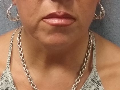 Liposuction of the Neck Before & After Patient #413